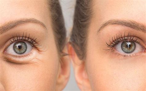 Improve Fine Lines Under your Eyes | Dermatology Care of Charlotte