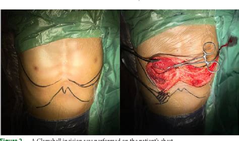 Figure 2 From Resection Of A Mature Giant Teratoma With Clamshell