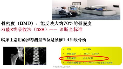 骨质疏松症的预防与治疗 好医术早读文章 好医术 赋能医生守护生命