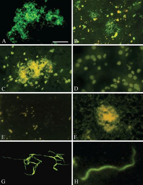 Bacterial Amyloid And Dna Are Important Constituents Of Senile Plaques