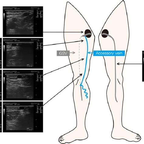 PDF Long Segment Hypoplasia Of Great Saphenous Vein With Posterior