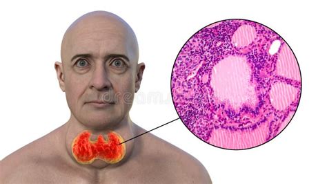 A Man With Enlarged Thyroid Gland 3d Illustration And Micrograph