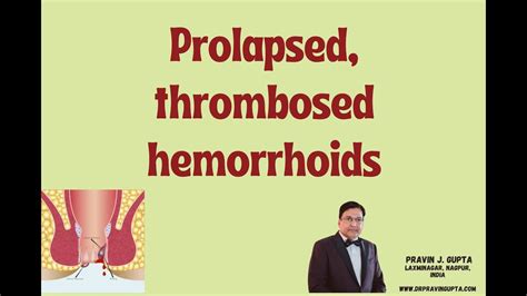 Laser Surgery Of A Prolapsed Thrombosed Hemorrhoids Youtube