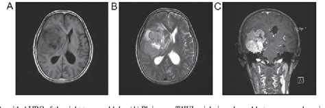 Figure 2 From MRI Features Of Intracranial Anaplastic