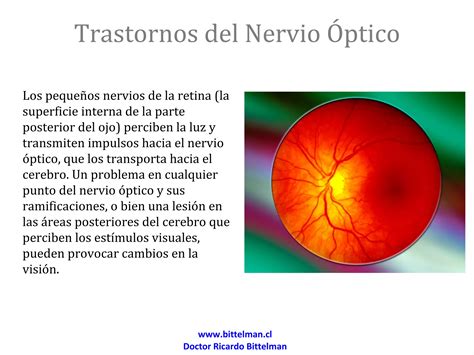 Trastornos Nervio Ptico Ppt