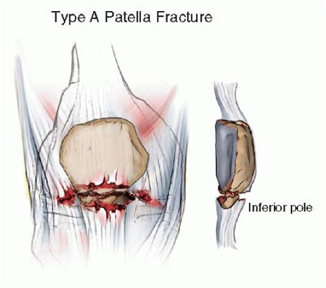 Patella Fractures Open Reduction Internal Fixation Musculoskeletal Key