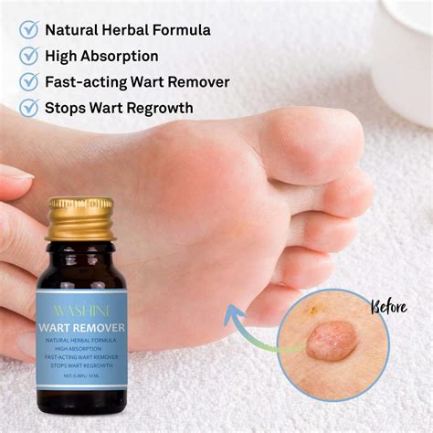 Avashine Wart Removal Painlessly Removes Common Hand And Plantar Wart