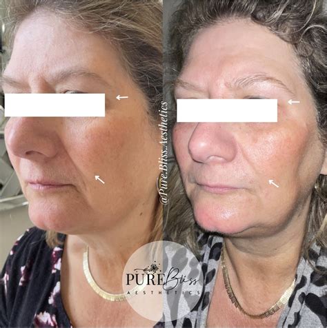 Prx Derm Perfexion Before And After — Pure Bliss Aesthetics