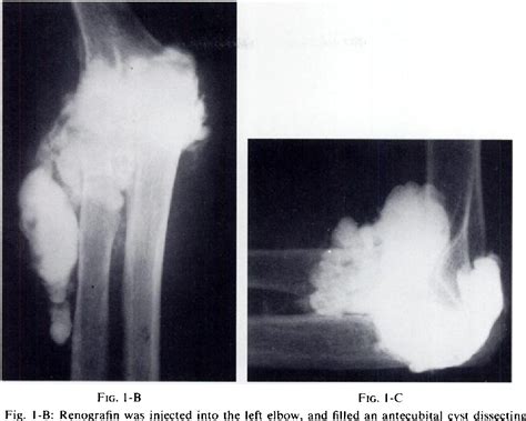 Figure I From Antecubital Cysts In Rheumatoid Arthritis A Corollary To