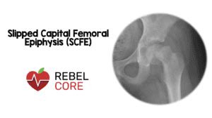 SCFE - REBEL EM - Emergency Medicine Blog