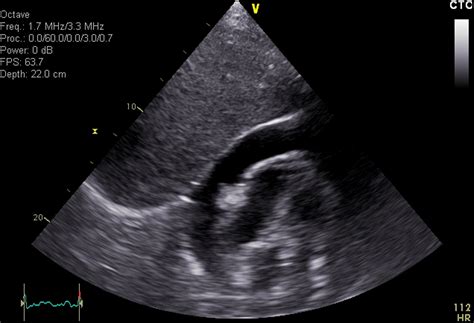 Acute Lupus Nephritis Image