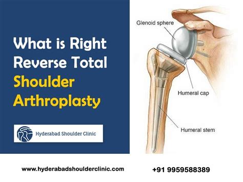 What Is Right Reverse Total Shoulder Arthroplasty Shoulder Clinic Hyderabad