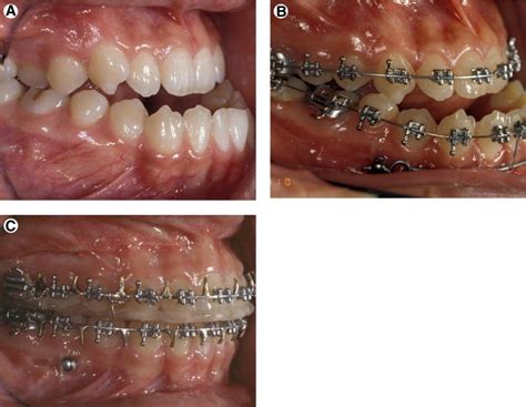 Class Iii Correction Using Biocreative Therapy C Therapy Seminars In Orthodontics