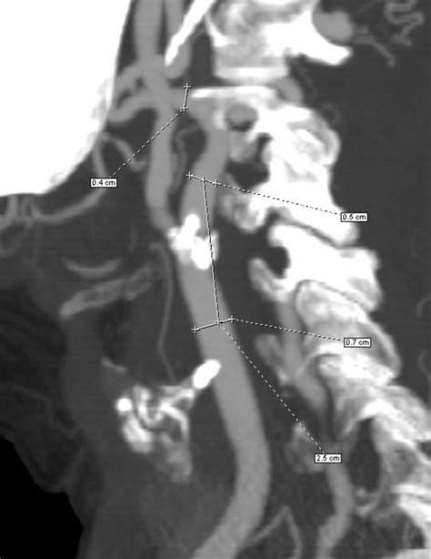 Carotis Angioplastie Mit Stentversorgung Operationsplanung DocCheck