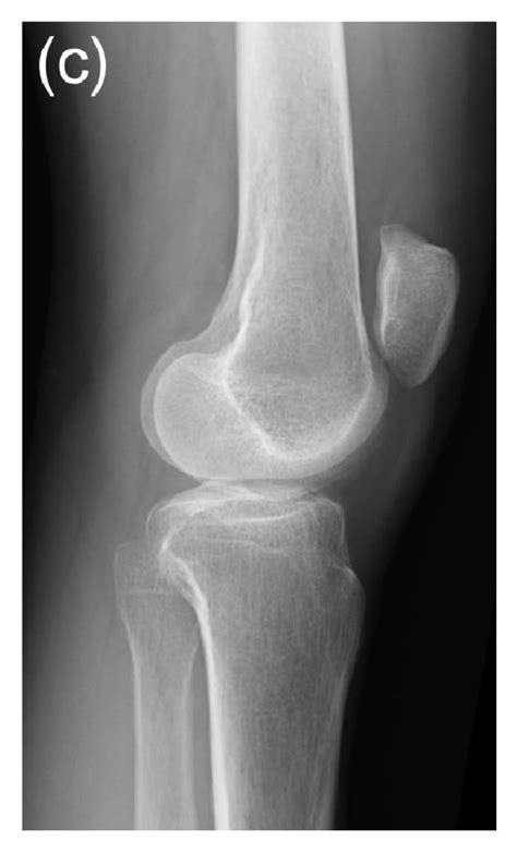 Plain Radiography Of Our Patient A Lateral View Of The Right Knee Download Scientific