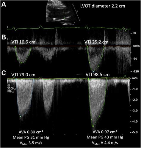 A Patient With Low-Flow, Low-Gradient Aortic Stenosis (Patient 1 ...