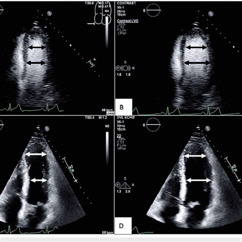 Apical Four Chamber View Of First Follow Up Echocardiogram After