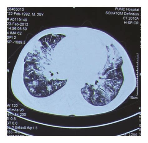 Chest CT It Shows Bilateral Patchy Ground Glass Opacities And