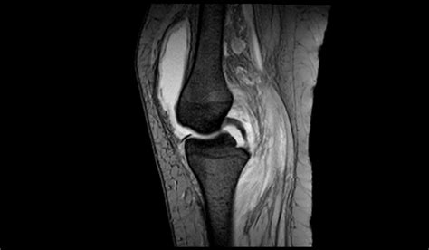 Knee Synovitis Mri Radiology Article On Knee Synovitis