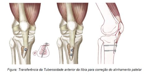 Tratamento Cirúrgico Da Condromalácia Patelar Dr Denys Aragão