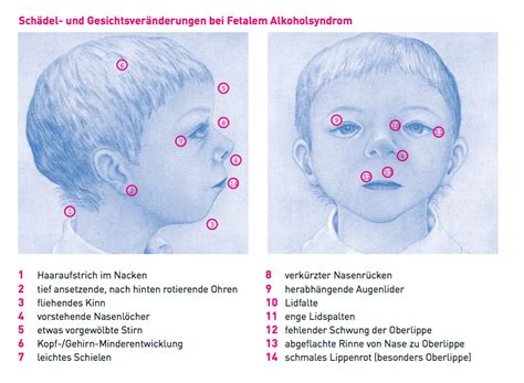 FASD Fetales Alkoholsyndrom Neurologische Vielfalt Aspies De