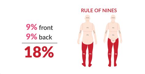 Rule Of Nines Burns Nursing Simple Nursing