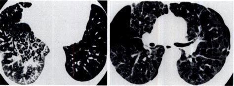 Lymphangitic Carcinomatosis Secondary Lobules Polygons Are Clearly Download Scientific