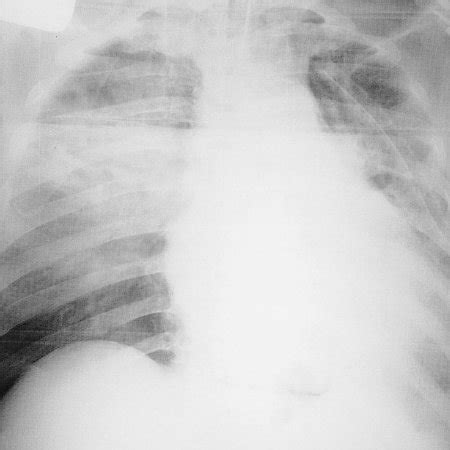 Chest X-ray reveals right hemopneumothorax with a chest tube inserted. | Download Scientific Diagram