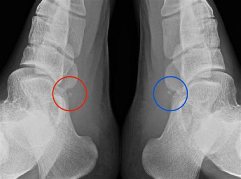 Posterior Tibial Tendon Insertion Pain 15 Yo Male — Sound Experience