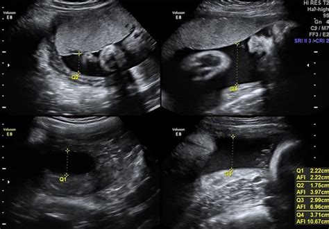 Amniotic Fluid - Excess, Low, and Leaking Amniotic Fluid