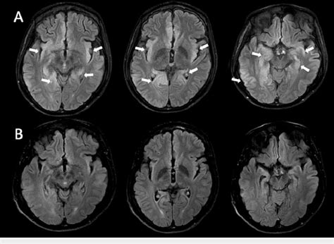 Hyperintense lesions observed in the axial FLAIR sequences, more ...