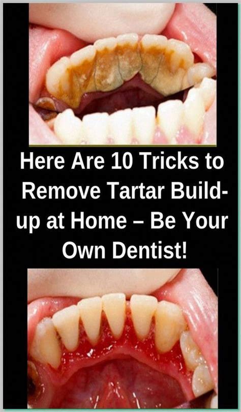 Get Rid Of Cavities And Tooth Decay Artofit