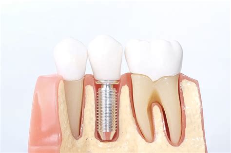 Cu Les Son Las Ventajas De Un Implante Dental Bqdc