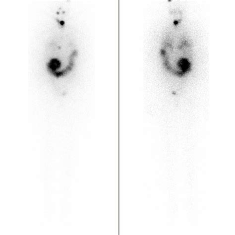 A Initial I 131 Whole Body Scan Revealing Two Focal Areas Of