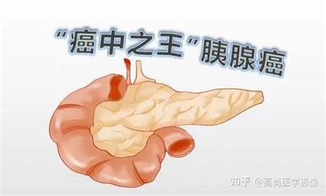 胰腺癌：4个症状，可能是胰腺呼救声 知乎