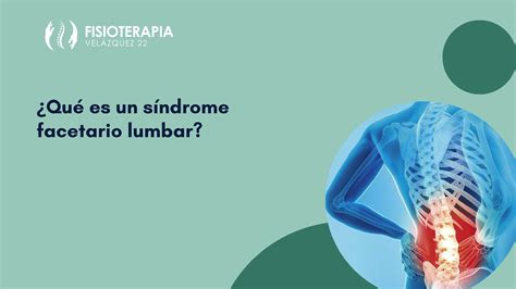 Qué es un síndrome facetario lumbar Fisioterapia Velázquez 22