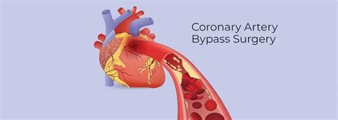 Coronary Artery Bypass Graft Surgery Rbh