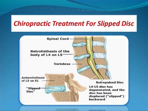 Slipped Disc Chiropractic Care Chiropractic Chiropractic Treatment