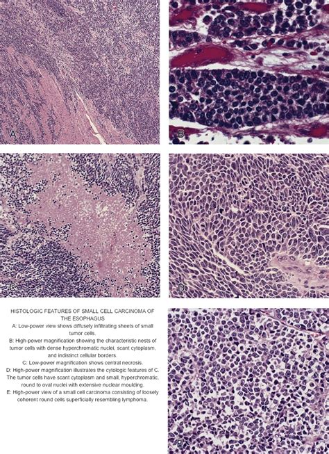 Pathology Outlines Small Cell Neuroendocrine Carcinoma