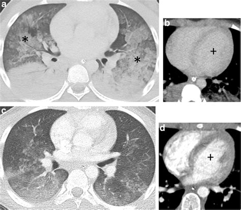 Myocardial Contusion With Pulmonary Edema 45 Year Old Male Presenting
