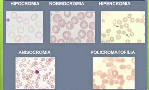 Predominância De Normocitose E Normocromia - Define hipocromia y normocromia (En dibujo). Necesito de su ayuda ...