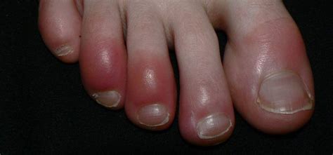 Chilblains Symptoms, Causes And Treatment Home Remedies