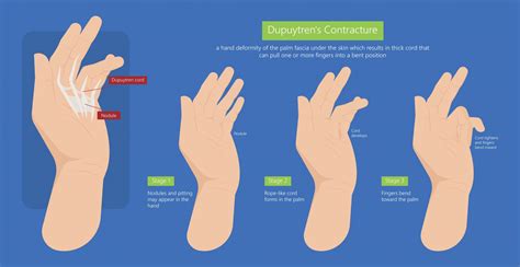 Dupuytrens Disease Treatment Arizona Center For Hand Surgery