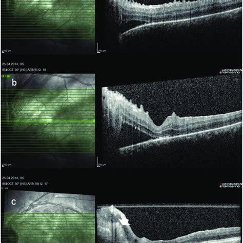 Preoperative And Postoperative Oct Scans Of Left Eye A Epiretinal