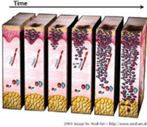 The Vertical Growth Phase Of Pigmented Skin Lesion Over Time