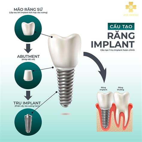 AVA Dental Viện Công Nghệ Trồng Răng Implant