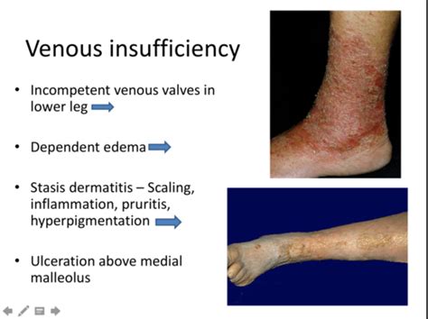 Leg Ulcers Flashcards Quizlet