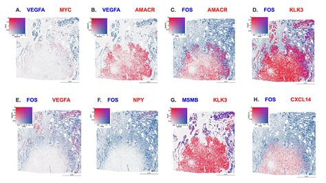 How High Definition Spatial Transcriptomics Single Cell Ffpe And