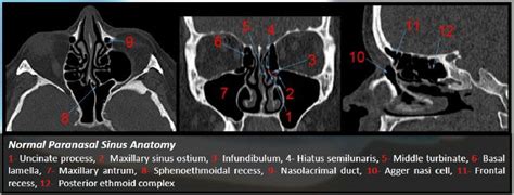 Functional Endoscopic Sinus Surgery