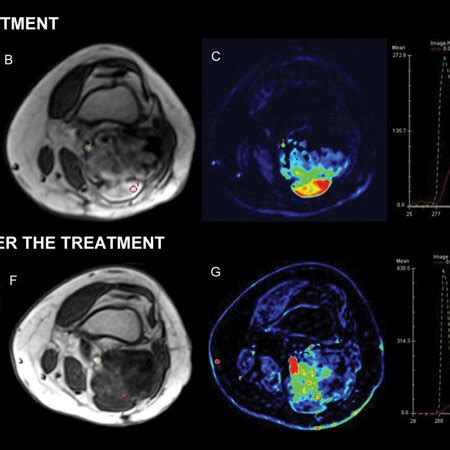 Tissue Characterization Of Soft Tissue Lesions Myxoid Liposarcoma In